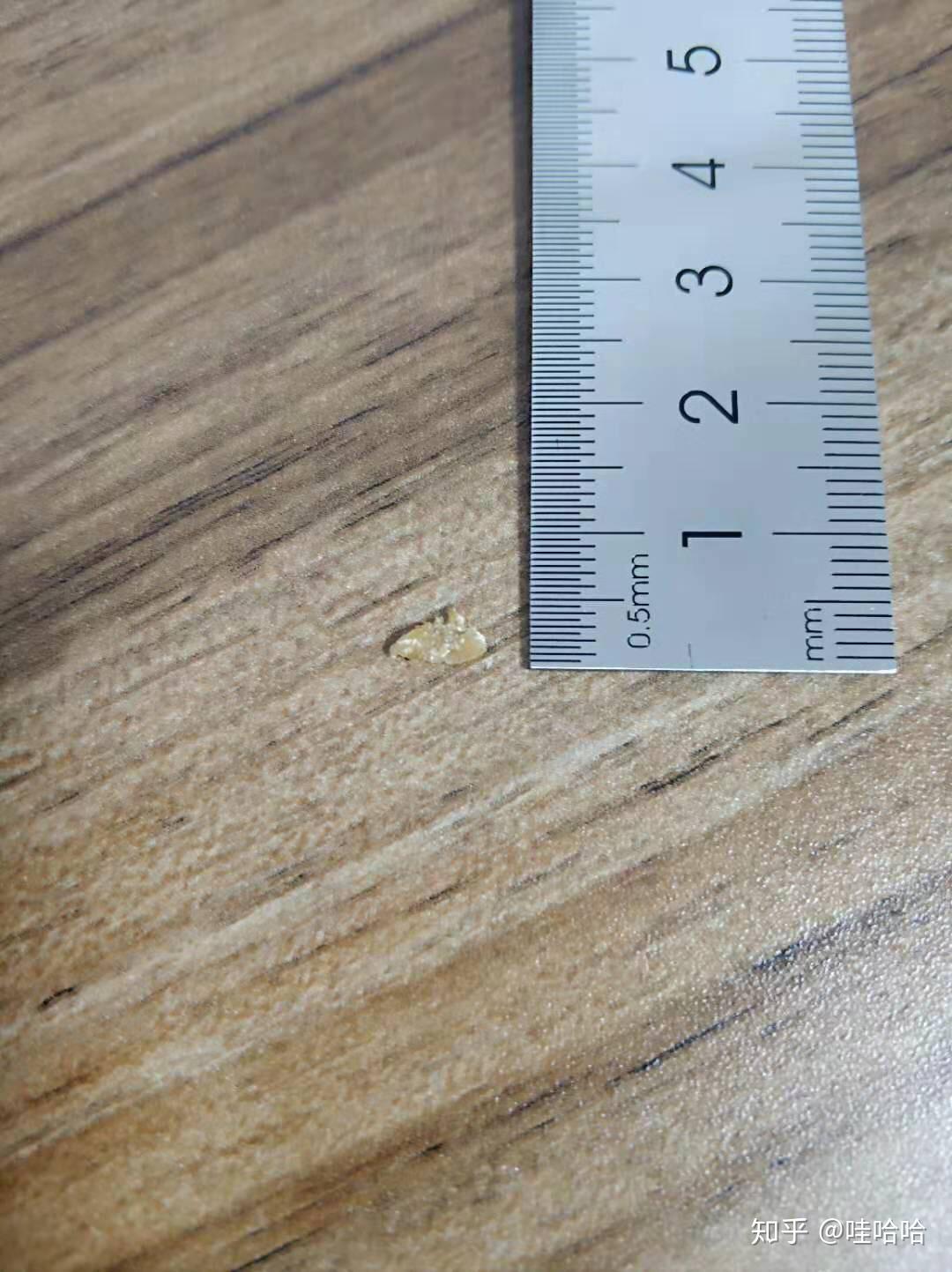 75*0.45*0.2cm肾结石出来了 - 知乎