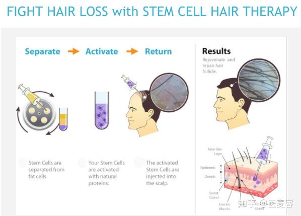 批准的脐带干细胞的新型非手术式头发修复项目——干细胞激光生发治疗
