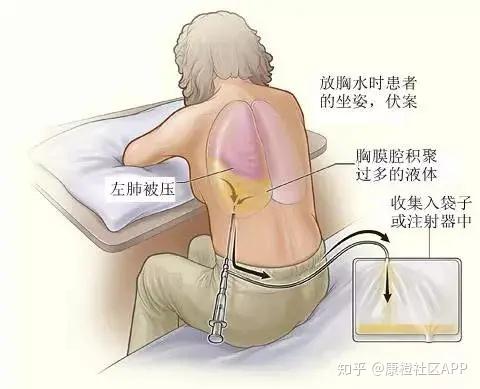 肿瘤患者最关心的问题:靶向药为什么会耐药?怎么延缓耐药? - 知乎