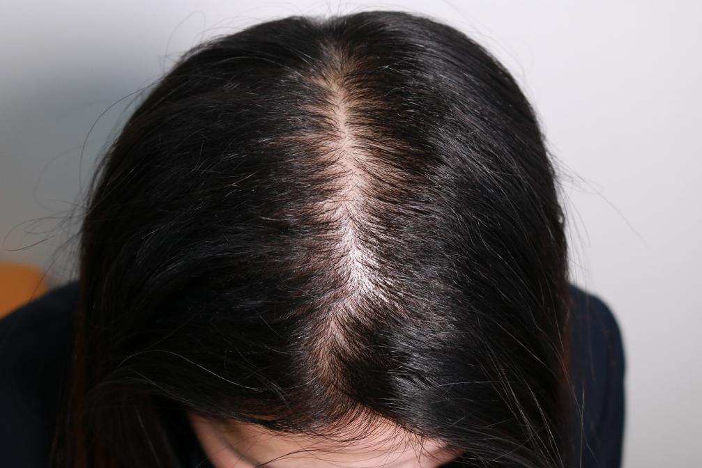女性脂溢性脱发怎么办 ?为何脂溢性脱发也会缠上女人?