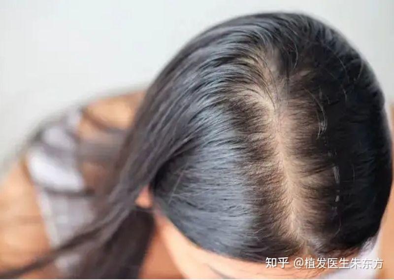 发缝变宽、发缝稀疏该如何拯救 - 知乎