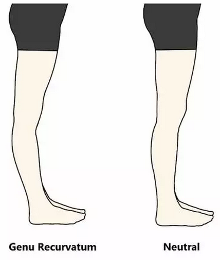 肌肉腿不理想,反倒是因为肌肉不够多?