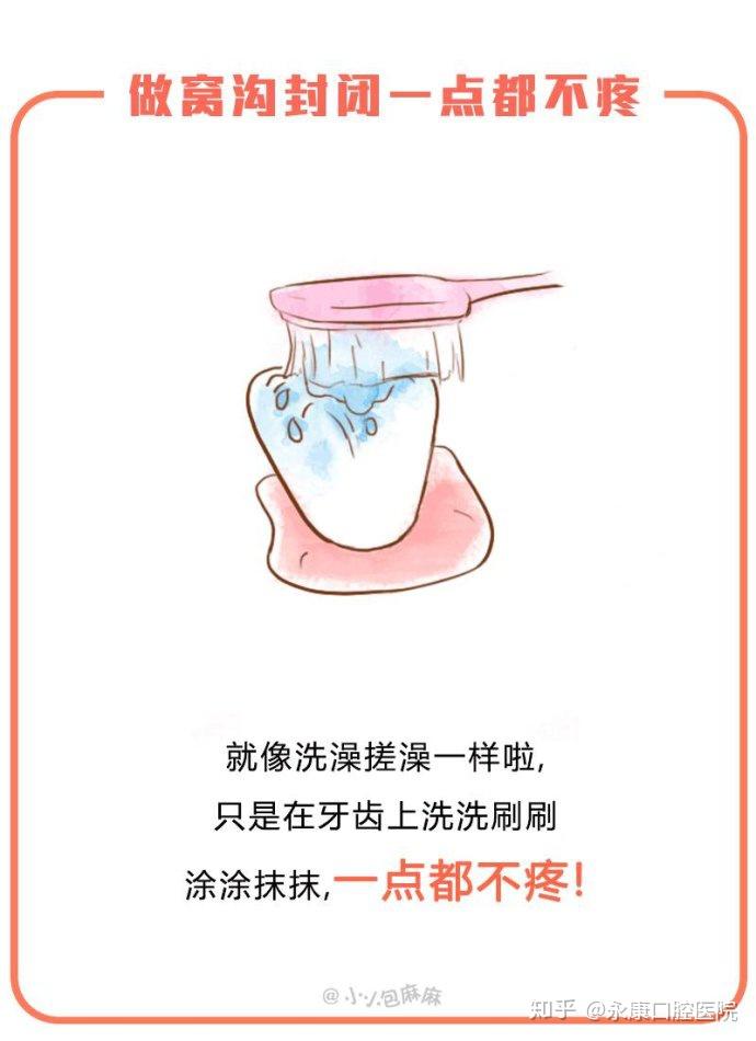 什么时候做窝沟封闭最好呢 v2-e8aa5412a0c9071fd12c54f74cb6c25d_r.jpg