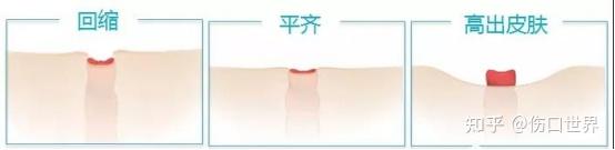 浅谈各类造口产品及其佩戴和更换 - 知乎