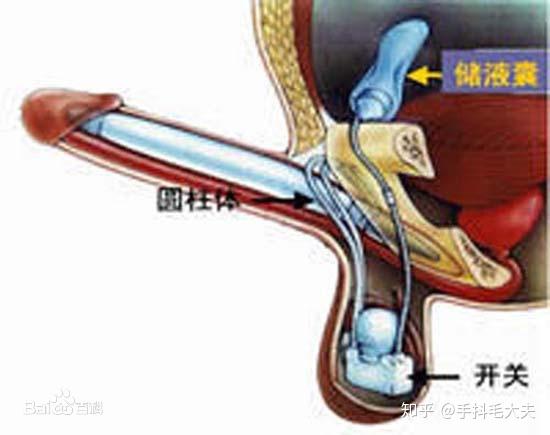 现代医学中最亮眼的手术是什么? 5 v2 e8d109db51ea2e7c8981dcf7bb5b9b6e 720w