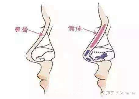 硅膠隆鼻和膨體隆鼻哪個更好隆鼻用哪種假體更安全隆鼻材料硅膠和膨體