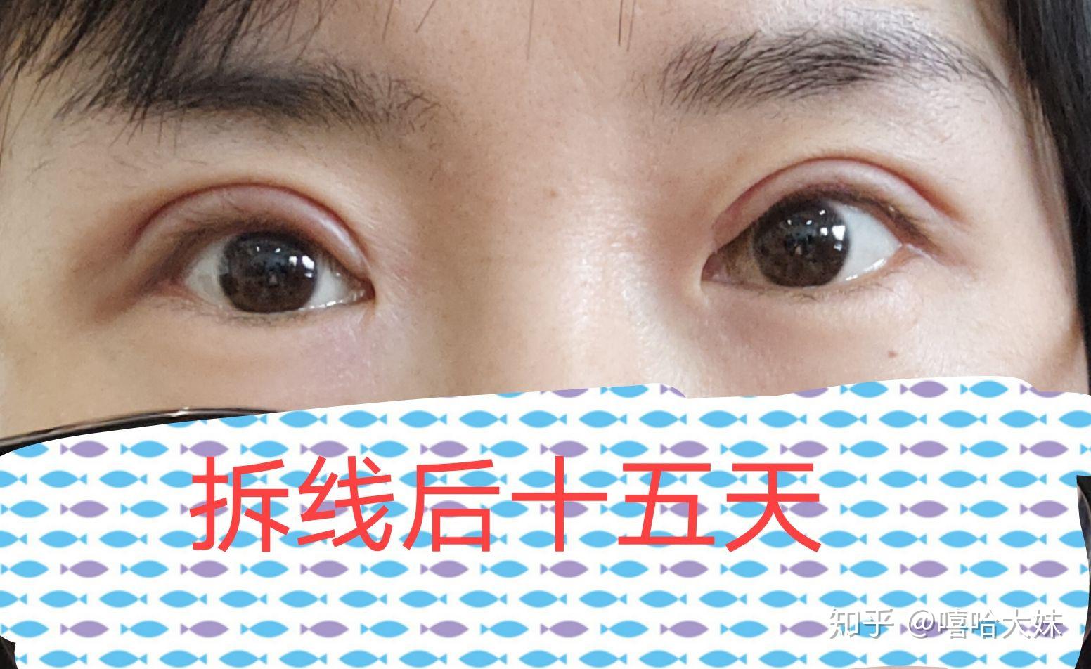 什么时候贴祛疤贴 v2-e900ddce0e0ce3d39c7e3fa7968c5a89_r.jpg