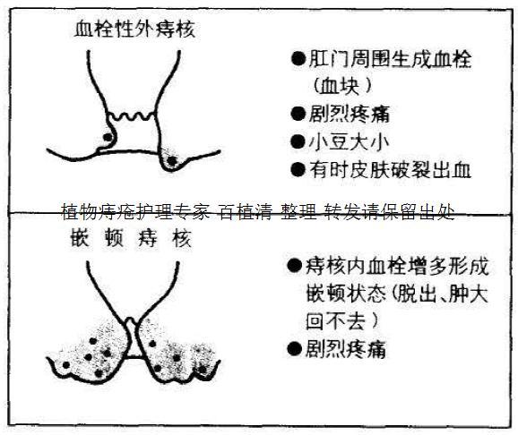 痔疮剧痛是咋回事 痔疮疼痛的最佳治疗方法是什么 收藏 转发 知乎