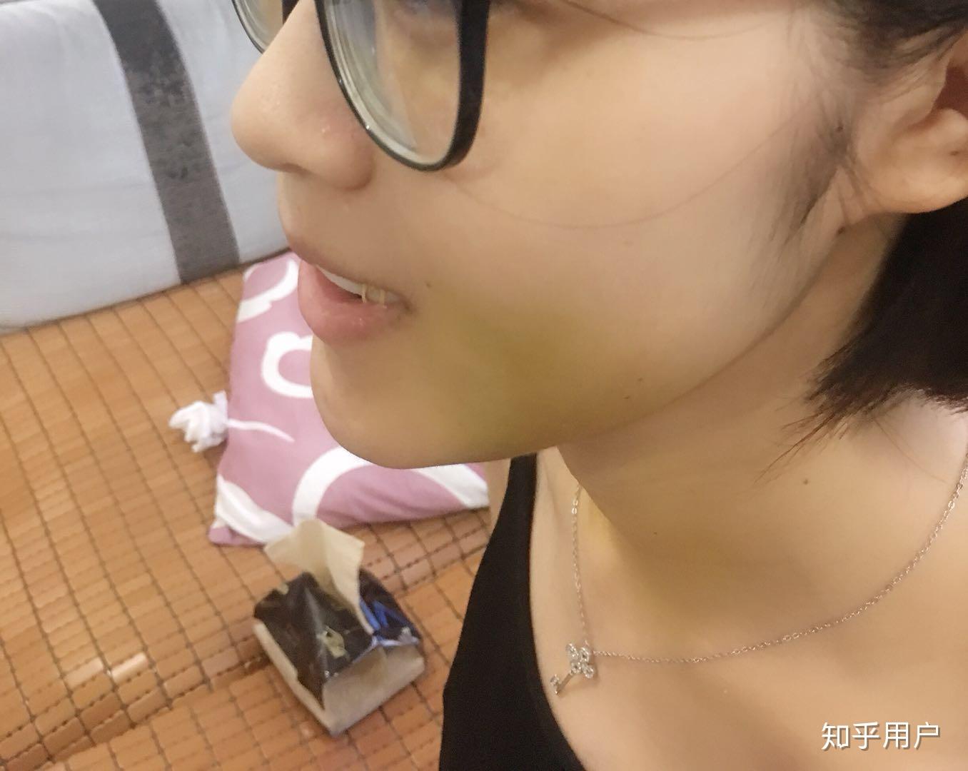 牙齿地包天(兜齿)是怎样的一种体验? - 知乎