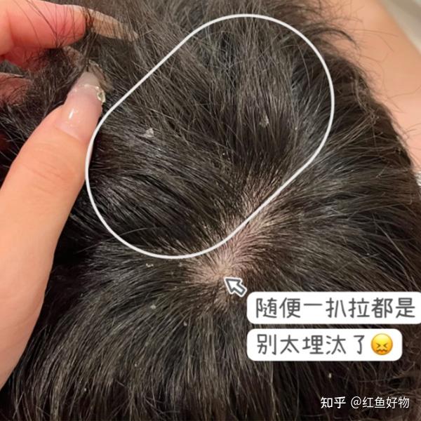 头皮屑多痒有小疙瘩用什么洗发露?推荐止痒效果好的洗发水 - 知乎