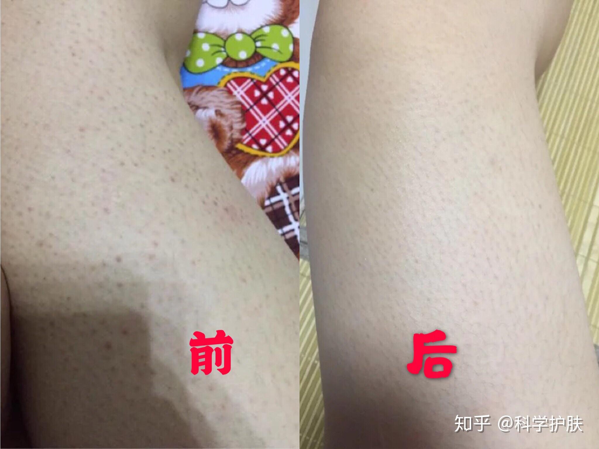 有鸡皮肤去除(鸡皮肤去除多少钱)