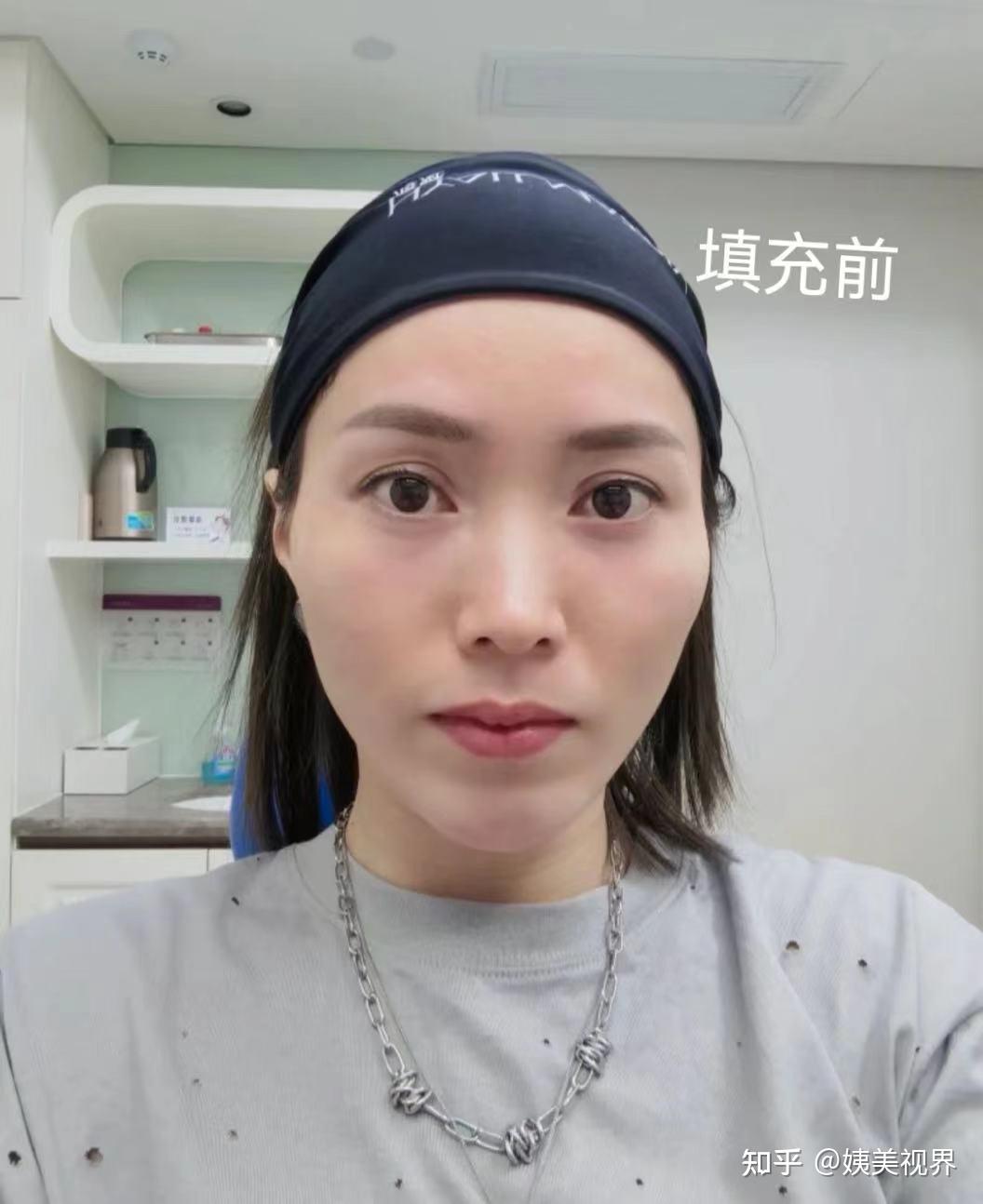 面部自体脂肪填充的并发症危险性有多高怎么避免
