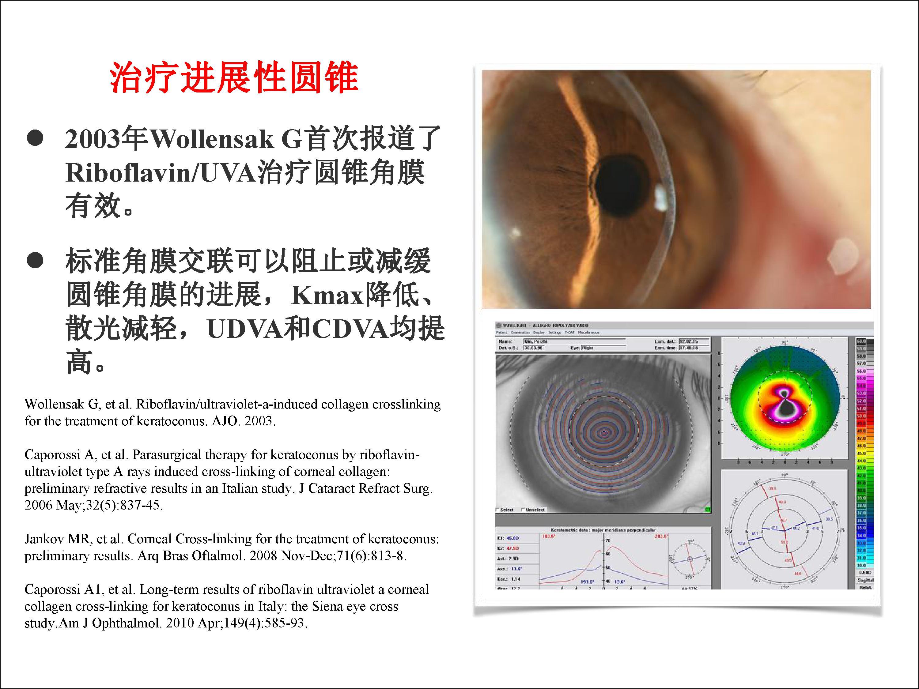 角膜交联术治疗圆锥角膜背景及原理介绍