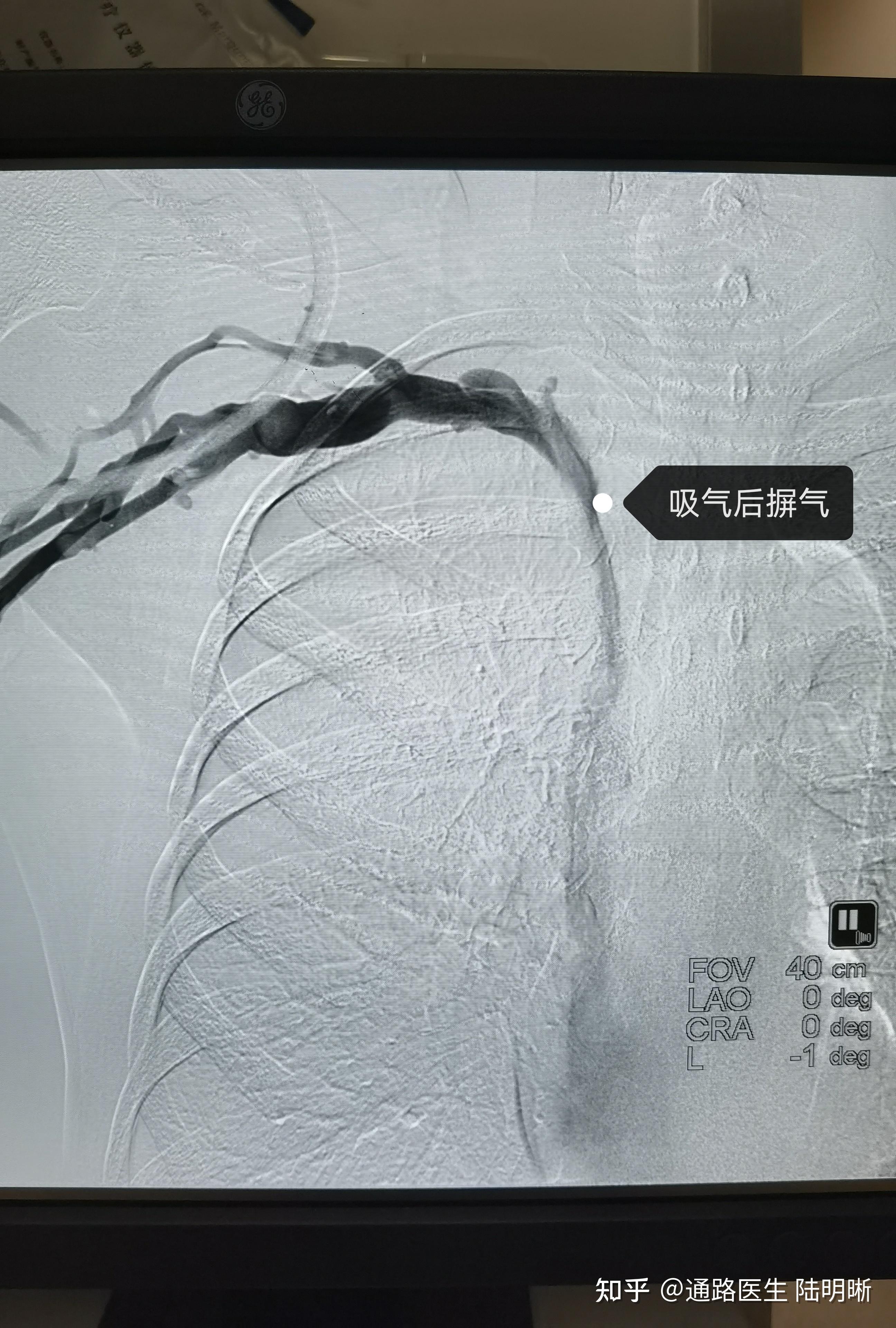 235呼吸运动对中心静脉ctv的影响