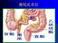 患者教育 || 成人闌尾炎 - 知乎