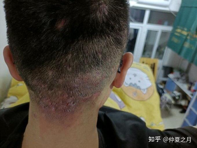 头皮毛囊炎怎么办?头皮长了很多痘痘怎么治? - 知乎