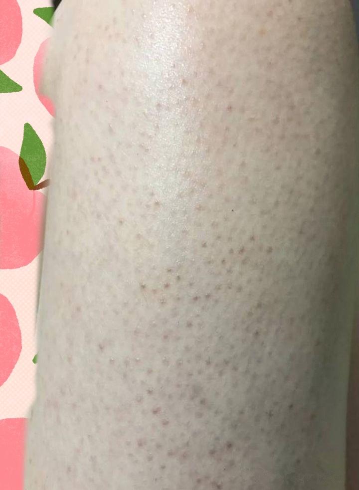 怀孕后皮肤变鸡皮(怀孕后皮肤变鸡皮是怎么回事) 怀孕后皮肤变鸡皮(怀孕后皮肤变鸡皮是怎么回事)