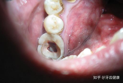 多是由于深龋未补致牙髓感染,或化学药物或温度刺激引起,其疼痛为自发