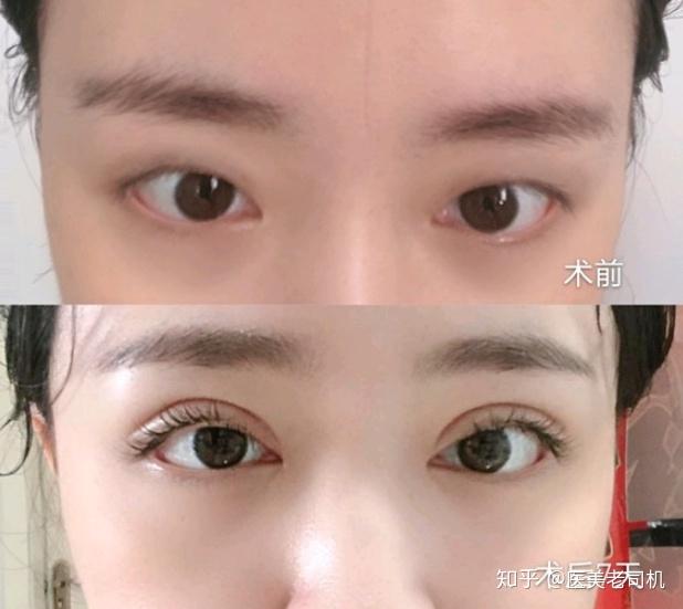 术前单眼皮,眼睛看起来无神,略显疲态,想通过双眼皮手术改善双眼无神