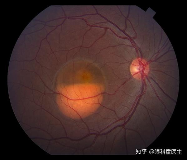 视网膜变性疾病——7、卵黄样黄斑营养不良 - 知乎
