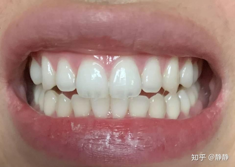 为什么长期刷牙,牙齿还很黄?