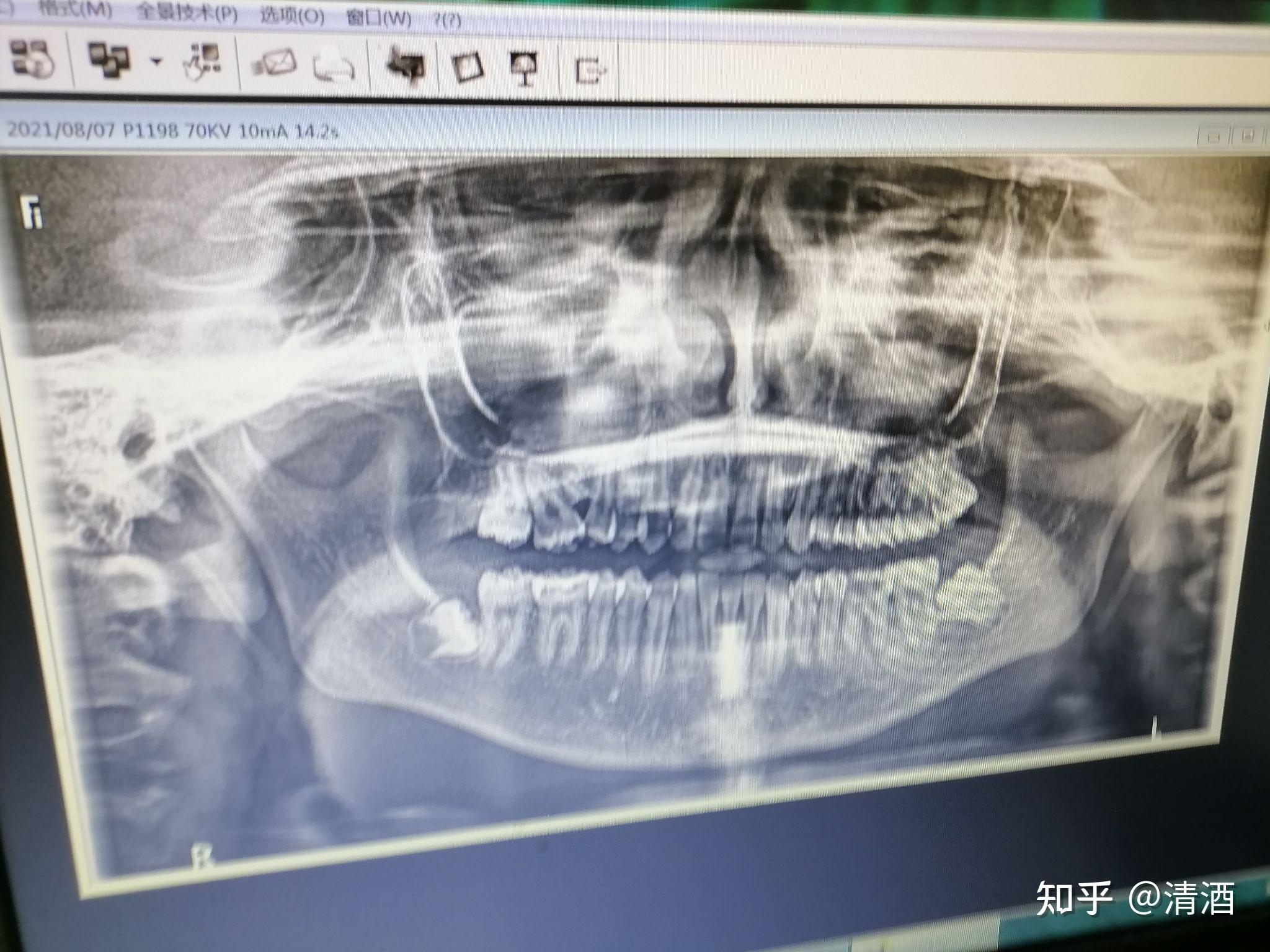 口腔拍攝x光片白色和黑色部分怎麼看