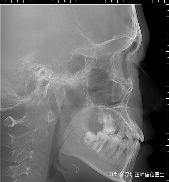 头骨侧面x光片图片