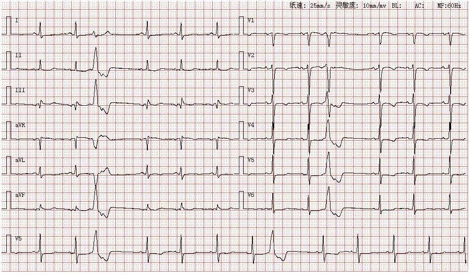 12s,由此判定其为窦性心律;各导联可见提前出现的宽大畸形的qrs波