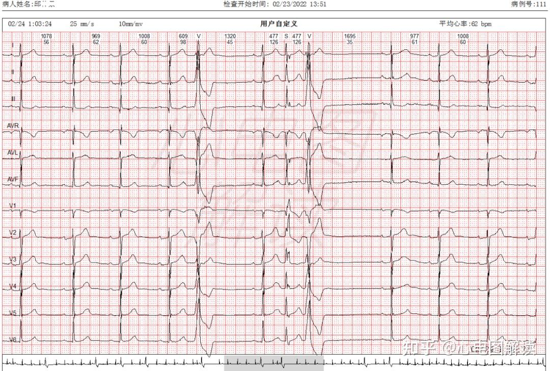 今天要分享的心电图成对出现的室早和房早
