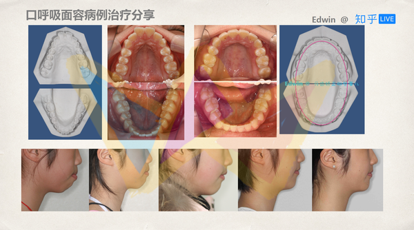 如何从小到大保护好牙齿?