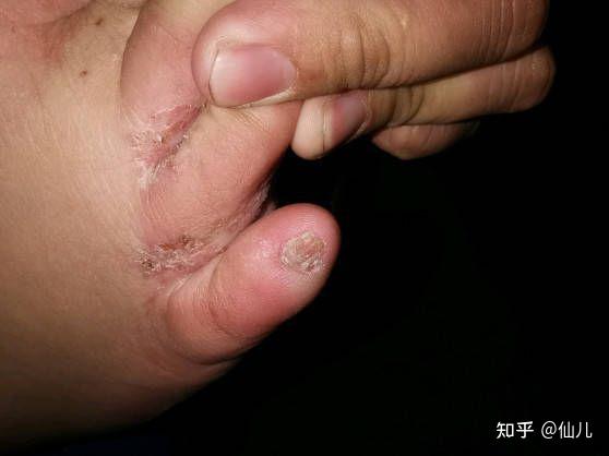 我的脚气就是在高中的时候被传染上的,那时候对脚气没有概念,经常穿