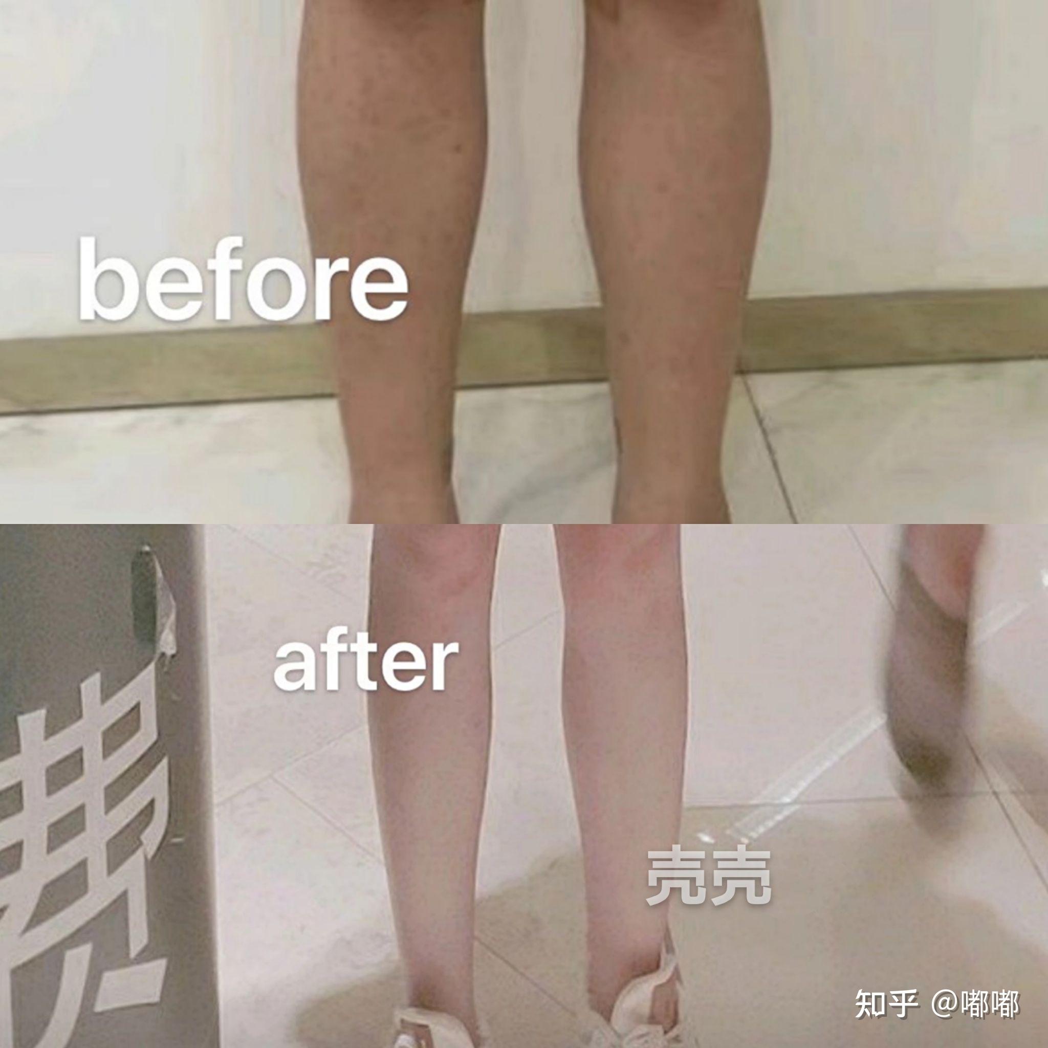 大腿環抽手術擺脫粗腿困擾抽脂術前全面評估|吳欣恆醫師|雅丰診所