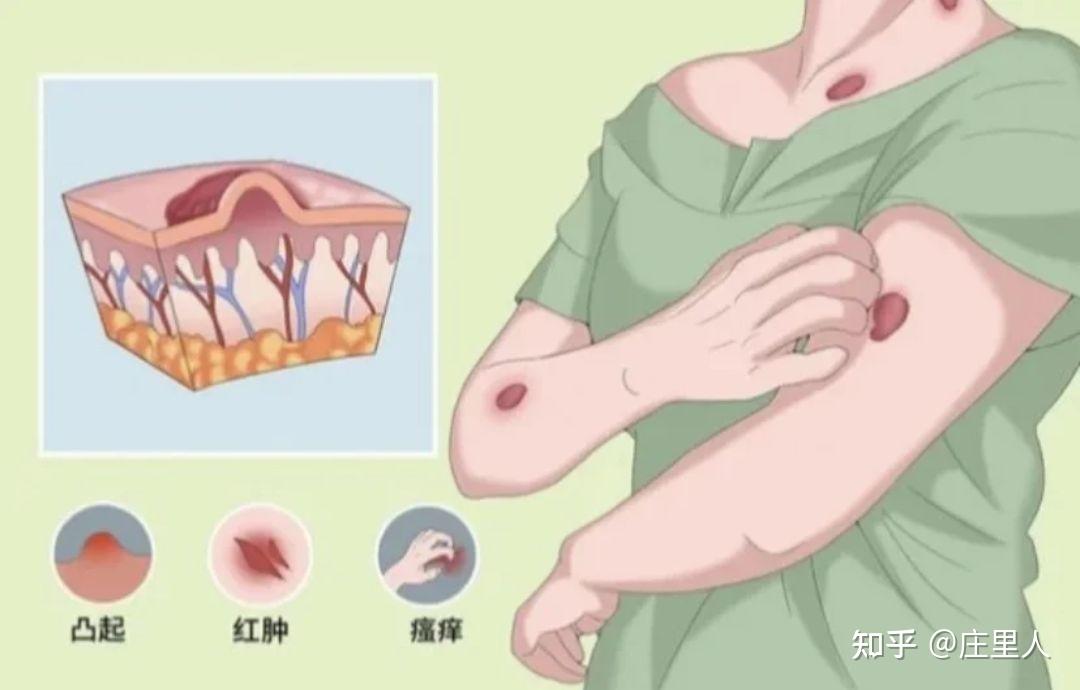 什么是结节性痒疹？结节性痒疹长啥样？ - 知乎