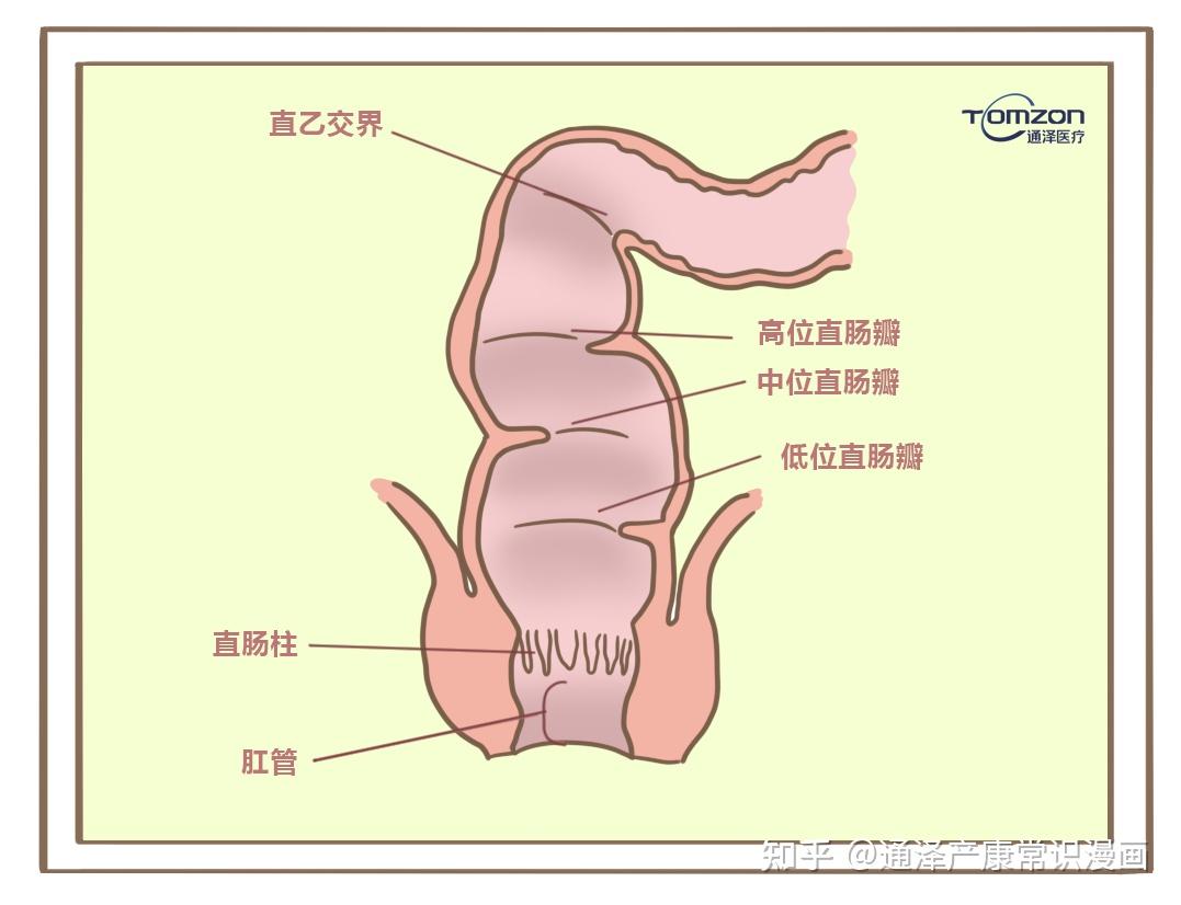 直肠膨出怎么办?