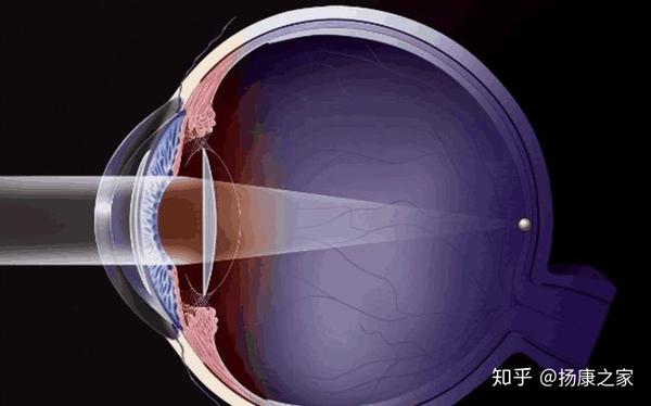 白內障有哪些先兆症狀當身邊的老人有這些表現時需要注意了