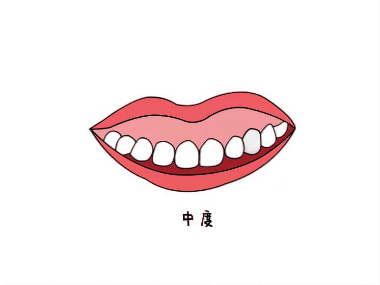 北京牙齿矫正|露龈笑是什么情况?牙齿矫正可以解决吗?