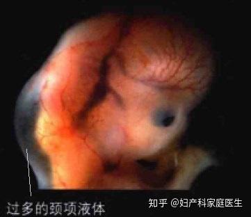 妊娠第3个月 9 12周母亲和胎儿 知乎