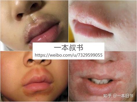 口周炎  一本叔书#口周炎#由外部刺激引起,也可能和含氟牙膏及蠕形螨