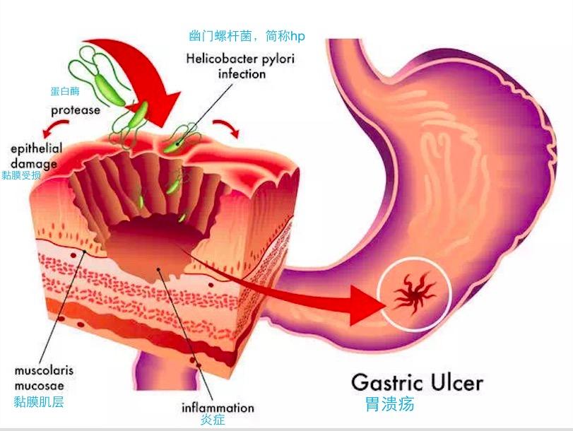 慢性胃炎 胃溃疡怎么养胃 知乎