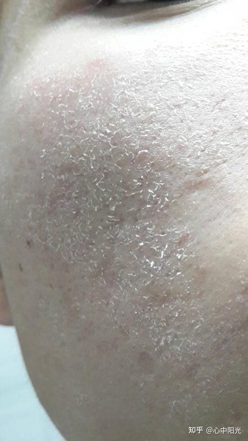 冬天干的起皮是屏障受损吗? - 知乎