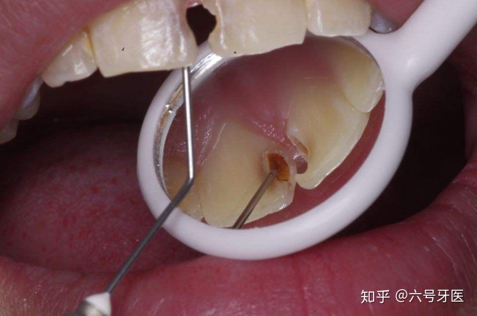 两颗牙齿之间的龋坏最讨人厌,一旦龋坏基本就是前后两颗牙齿,塞牙妥妥