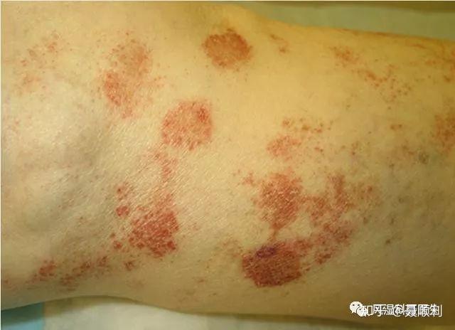 比如1,蕁麻疹血管炎(urticarial vasculitis, uv):這是一個慢性病.