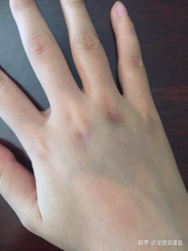 手背抽筋似的疼痛怎么回事?处理方法如下