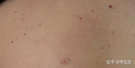 身上长了很多 红痣 好害怕 身上红痣与血痣图片 双偶网