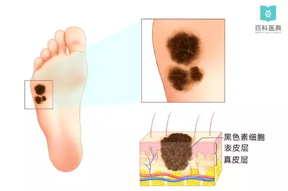 双生痣百科简介 v2-ea8a71410a9f137037f1b1c1cb368e2d_r.jpg