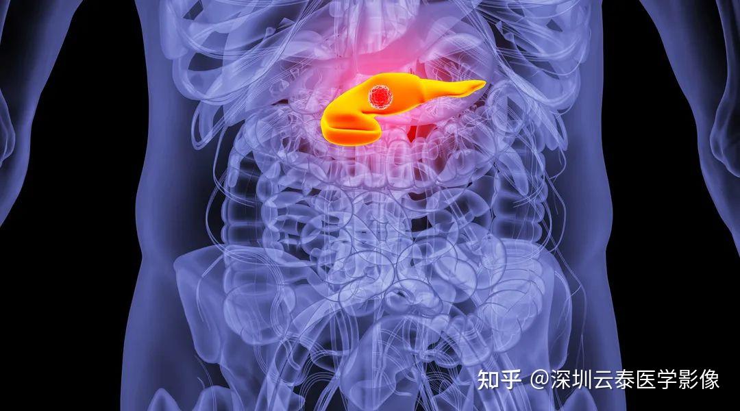 云泰健康科普中位生存期仅4个月胰腺癌为何被称为癌中之王