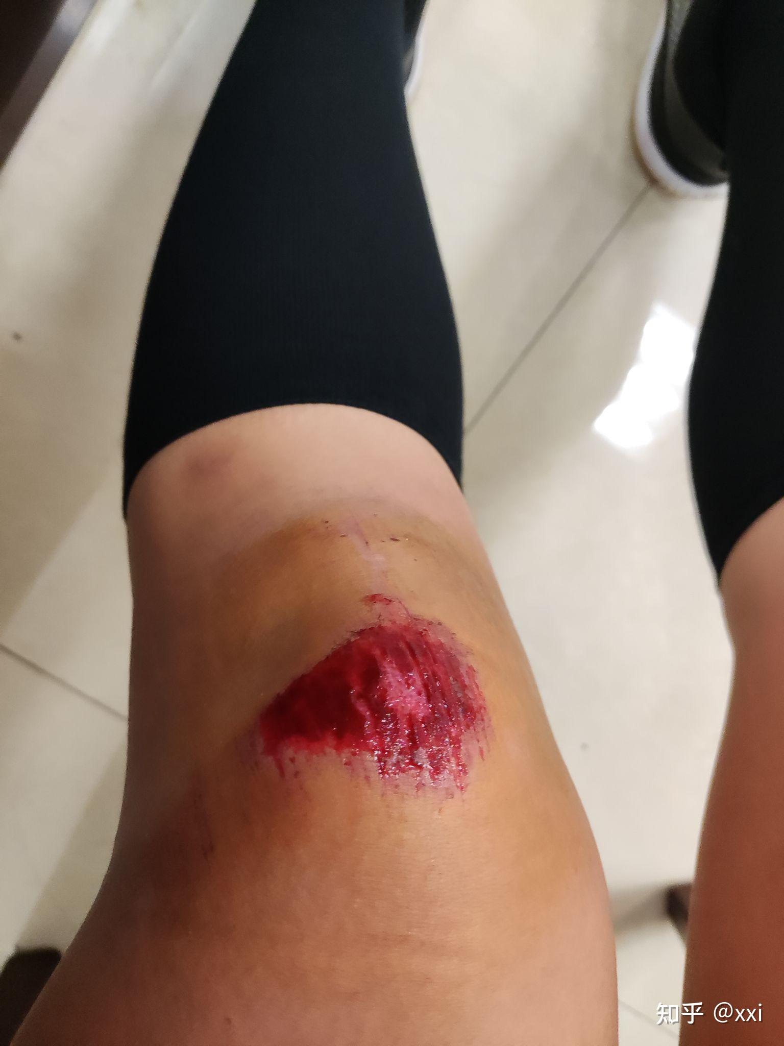 骑电动车摔伤了膝盖第四天了涂红霉素软膏还是阿莫西林的药粉哪个结疤