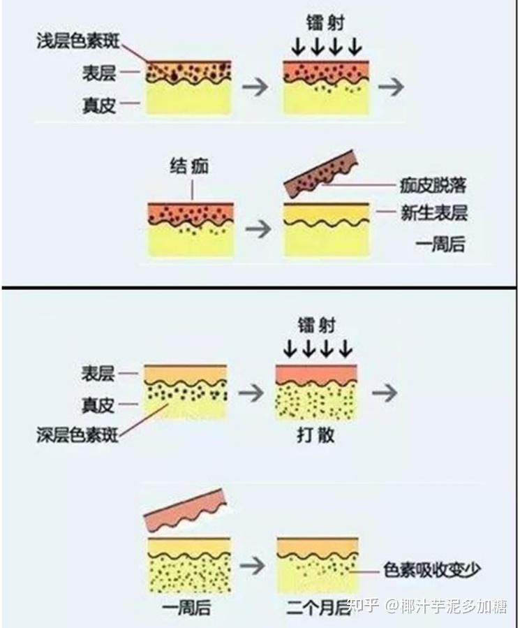 做完医美反黑怎么办?有哪些可以用的精华液? - 知乎