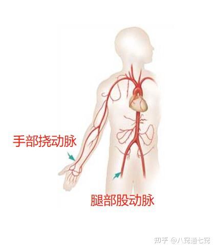 冠脉造影是局部麻醉后,从手部桡动脉或者大腿根部的股动脉做穿刺,进入