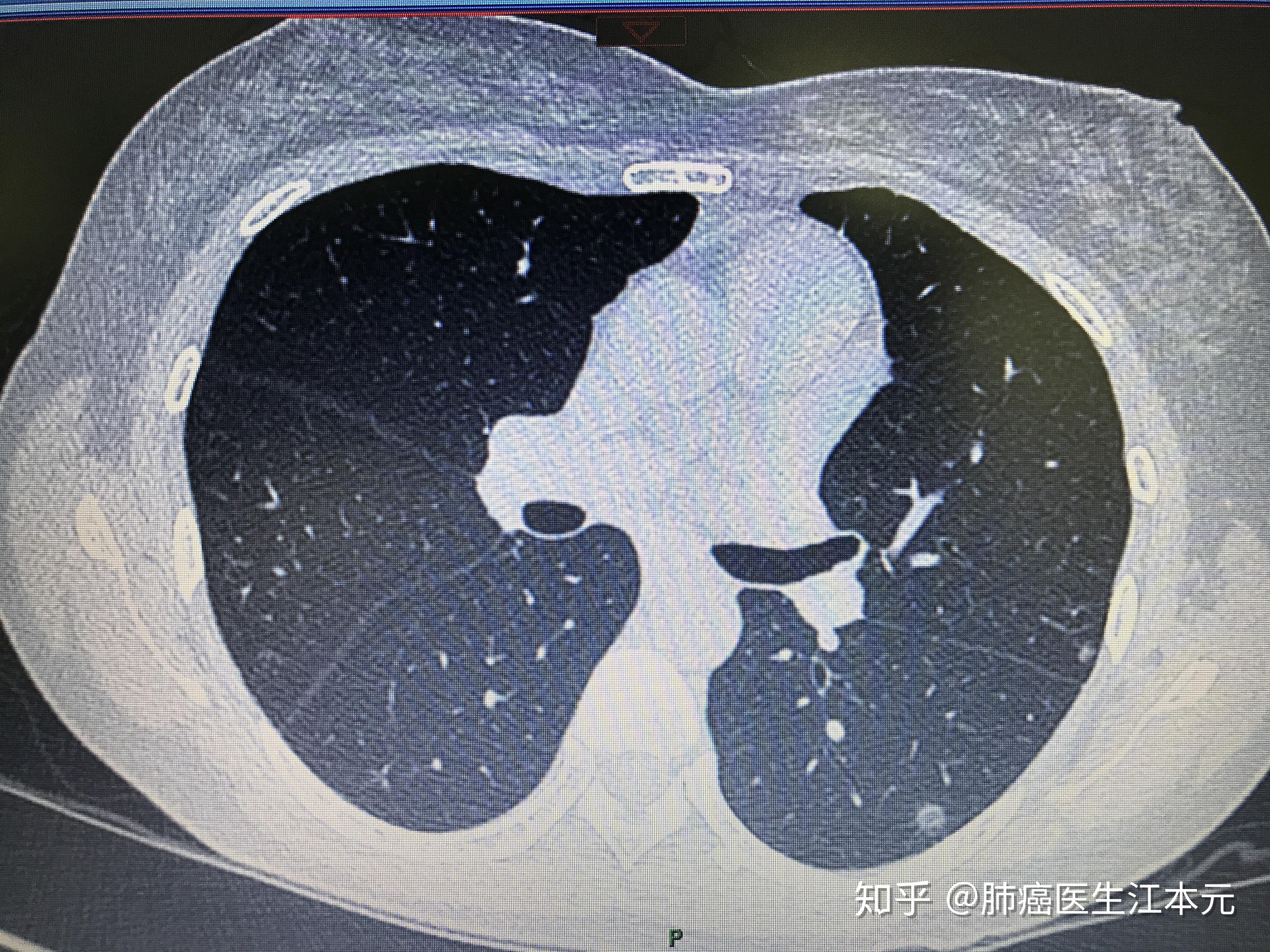 肺癌t2图片